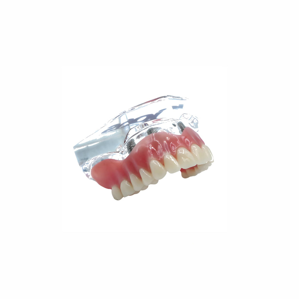 Seum Medi Upper Overdenture Jaw Model