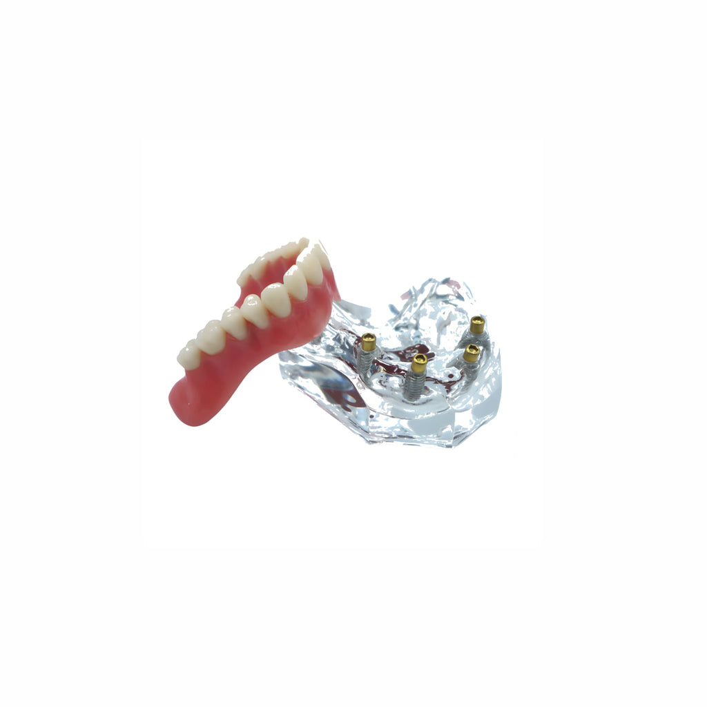 Seum Medi Upper Overdenture Jaw Model